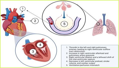Can an ECG detect pulmonary embolism?