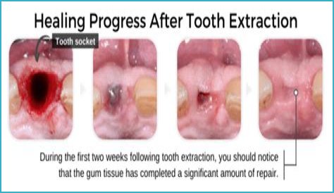 How long does it take for a molar extraction to heal?